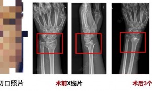 打一针就能治疗粉碎性骨折,浙大团队研发出全球首款“骨胶水”
